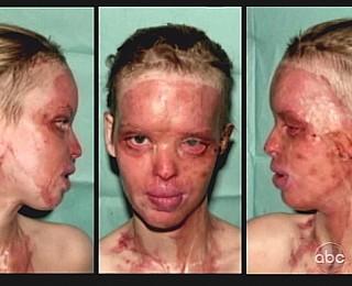 Katie Piper Model Säure Opfer Anschlag Freund neues Leben Katie Piper Model Säure Opfer Anschlag Freund neues Leben