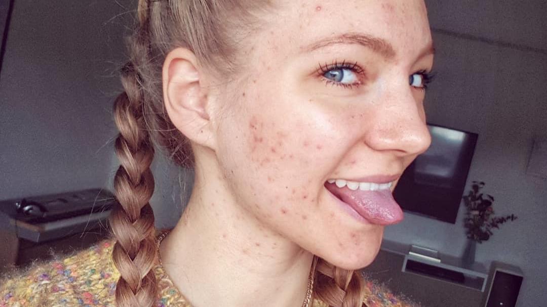Hanna Bohnekamp: Ex-GNTM-Zweite steht zu ihren Hautunreinheiten Hana Bohnekamp