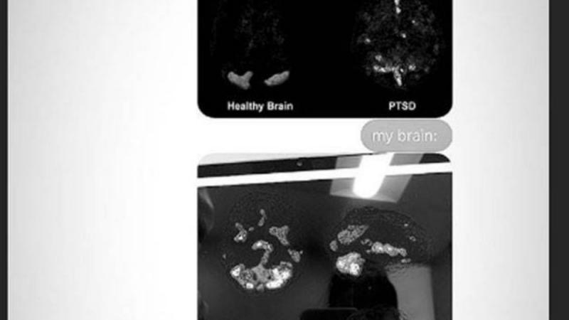 Posttraumatische Belastungsstörung: Ariana Grande postet Bild ihres Gehirns Ariana Grande postet Gehirnscan