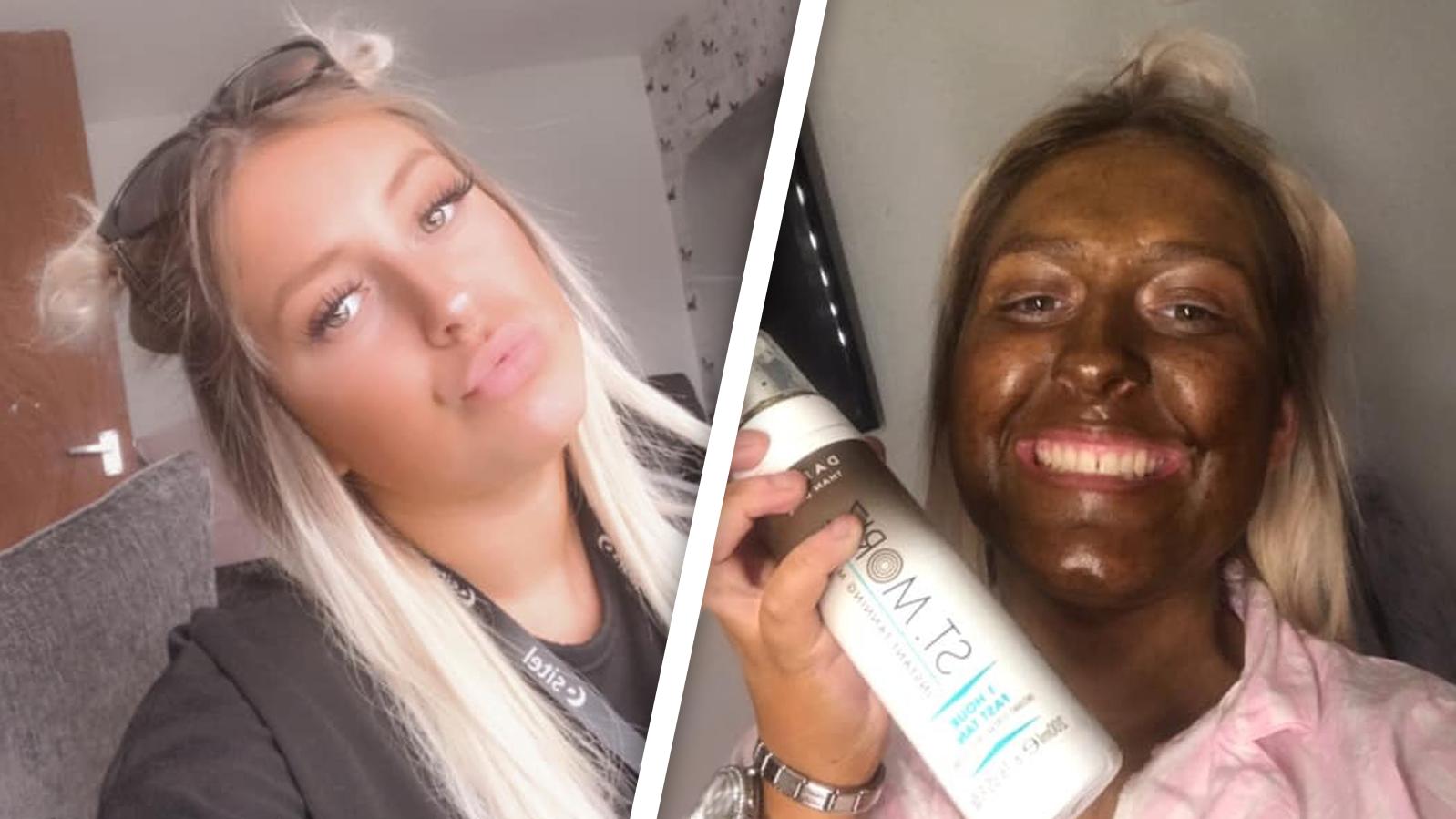 Nach Tanning-Fail einer Britin: So entfernen Sie Selbstbräuner mit einfachen Hausmitteln Kelsey Chambers vor und nach dem Selbstbräuner-Unfall.
