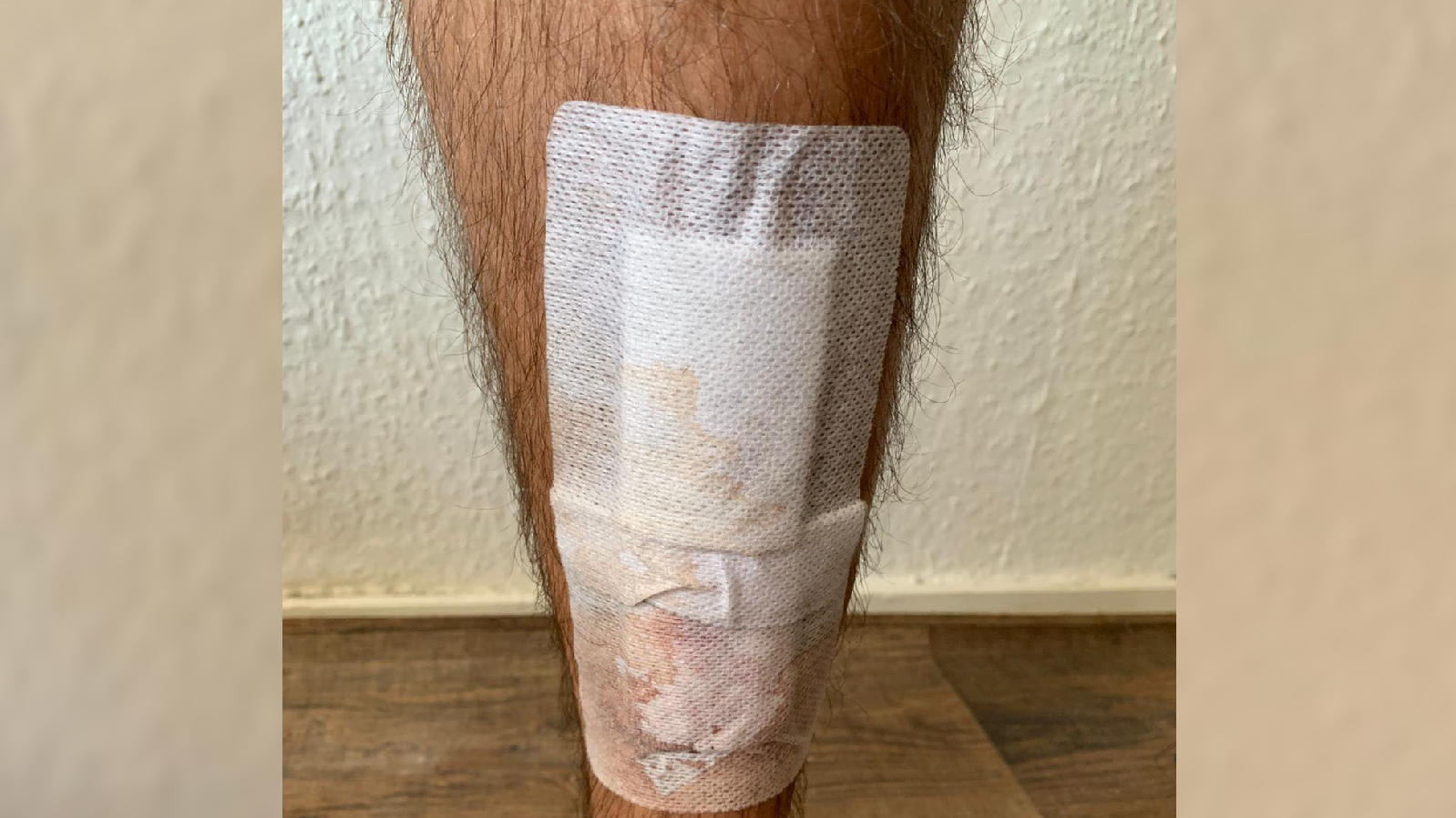 Von homophoben Hassern: "Bachelor in Paradise"-Star Rafi Rachek auf offener Straße verprügelt Auch Rafi Racheks Bein hat Blessuren davongetragen.