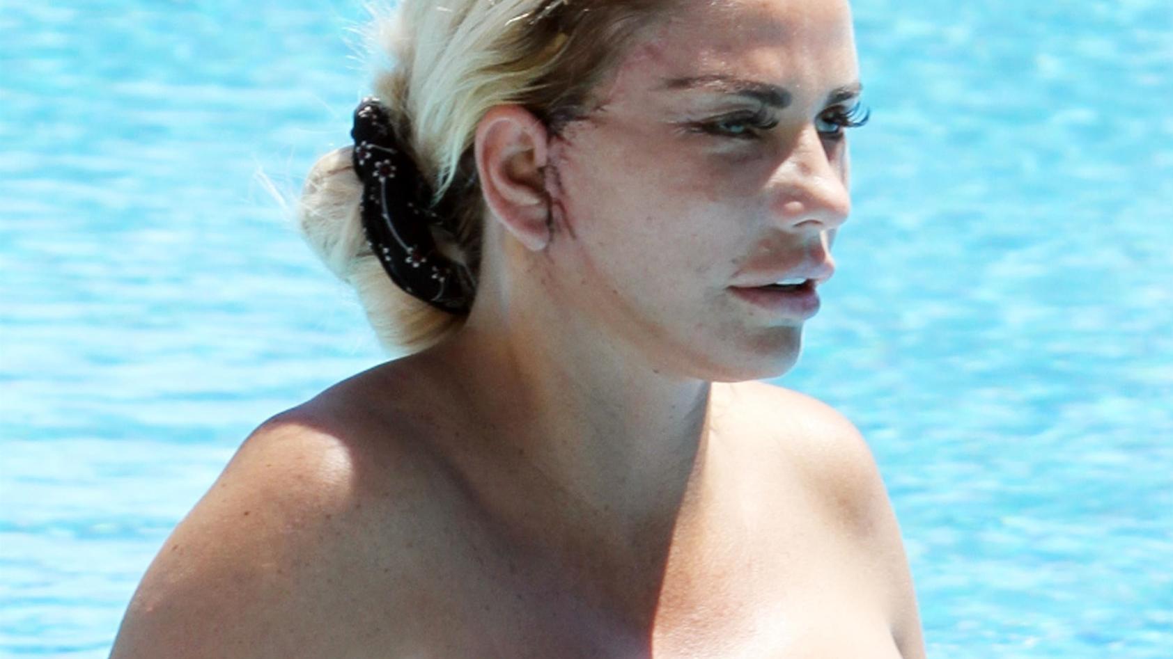 Die Pechvogel-Akte von Katie Price Katie Price nach einem Face-Lifting