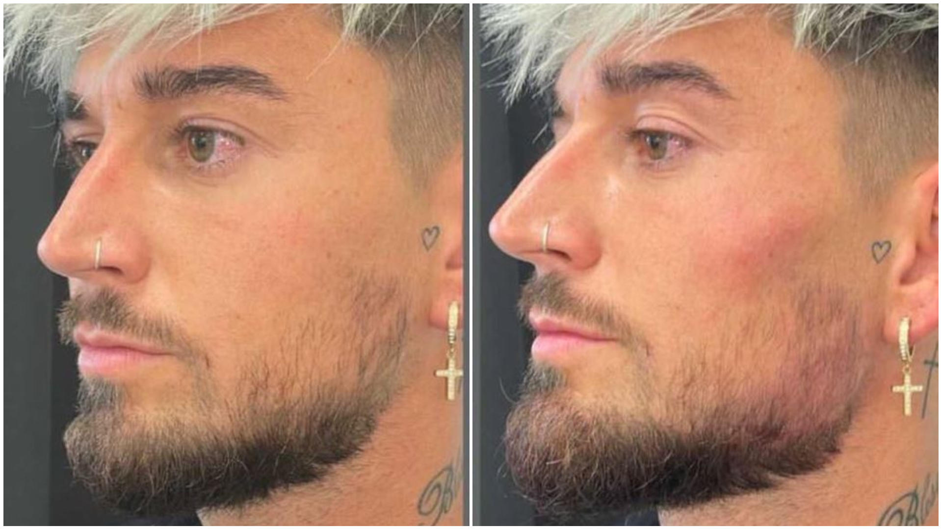 Mike Heiter: Ex-„Love Island“-Star lässt sich für den Urlaub das Gesicht unterspritzen Mike Heiter zeigt sein "neues" Gesicht.