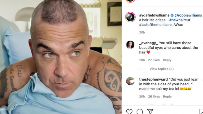 Robbie Williams akzeptiert seinen Haarausfall Robbie Williams akzeptiert seinen Haarausfall