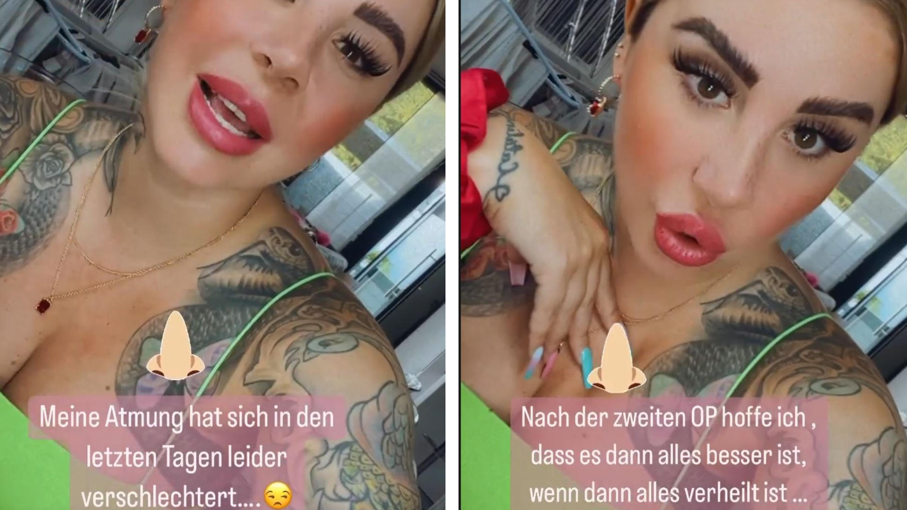 Nase voll? Kate Merlan hat nach ihrer Nasen-OP gesundheitliche Beschwerden Kate Merlan setzt ihre Hoffnungen auf die zweite OP