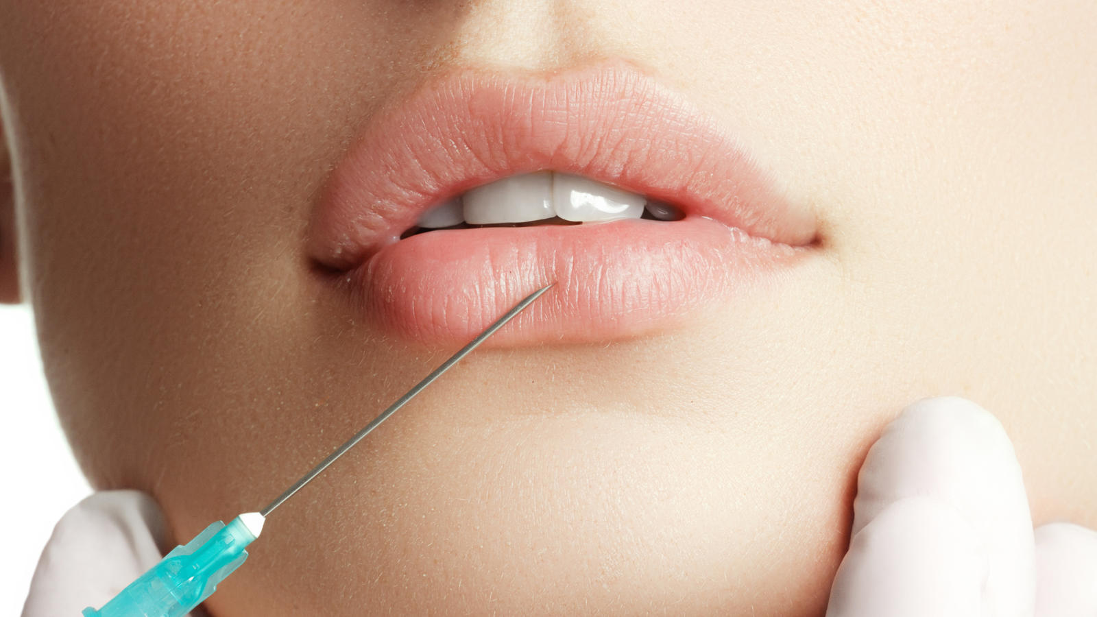 Verpfuschte Beauty-OP: Frau (22) droht Lippen-Amputation Lippen aufspritzen