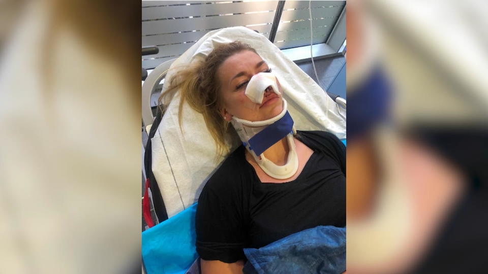 "Paradise Hotel"-Star im Krankenhaus Miriam Behrens: Nase gebrochen nach E-Roller-Crash