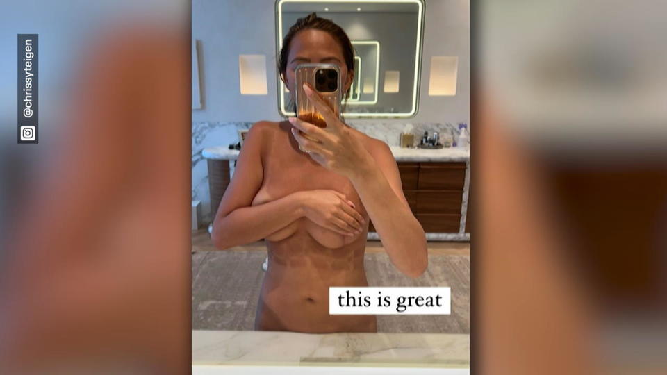 Model oben ohne auf Instagram Bräunungsfail bei Chrissy Teigen