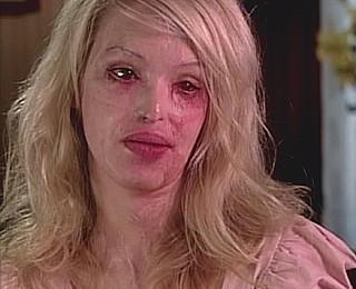Katie Piper Model Säure Opfer Anschlag Freund neues Leben