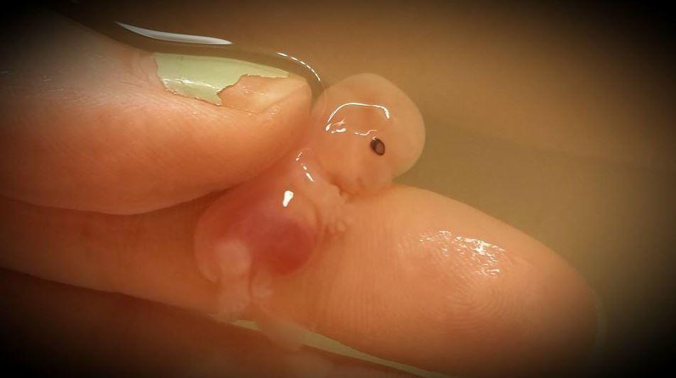 Nach Fehlgeburt: Mutter fotografiert toten Embryo.