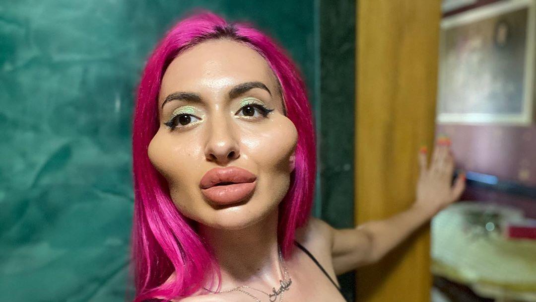 Instagram-Model Anastasiia aus Kiew spritzt sich selber Hyaluronsäure unter die Haut.
