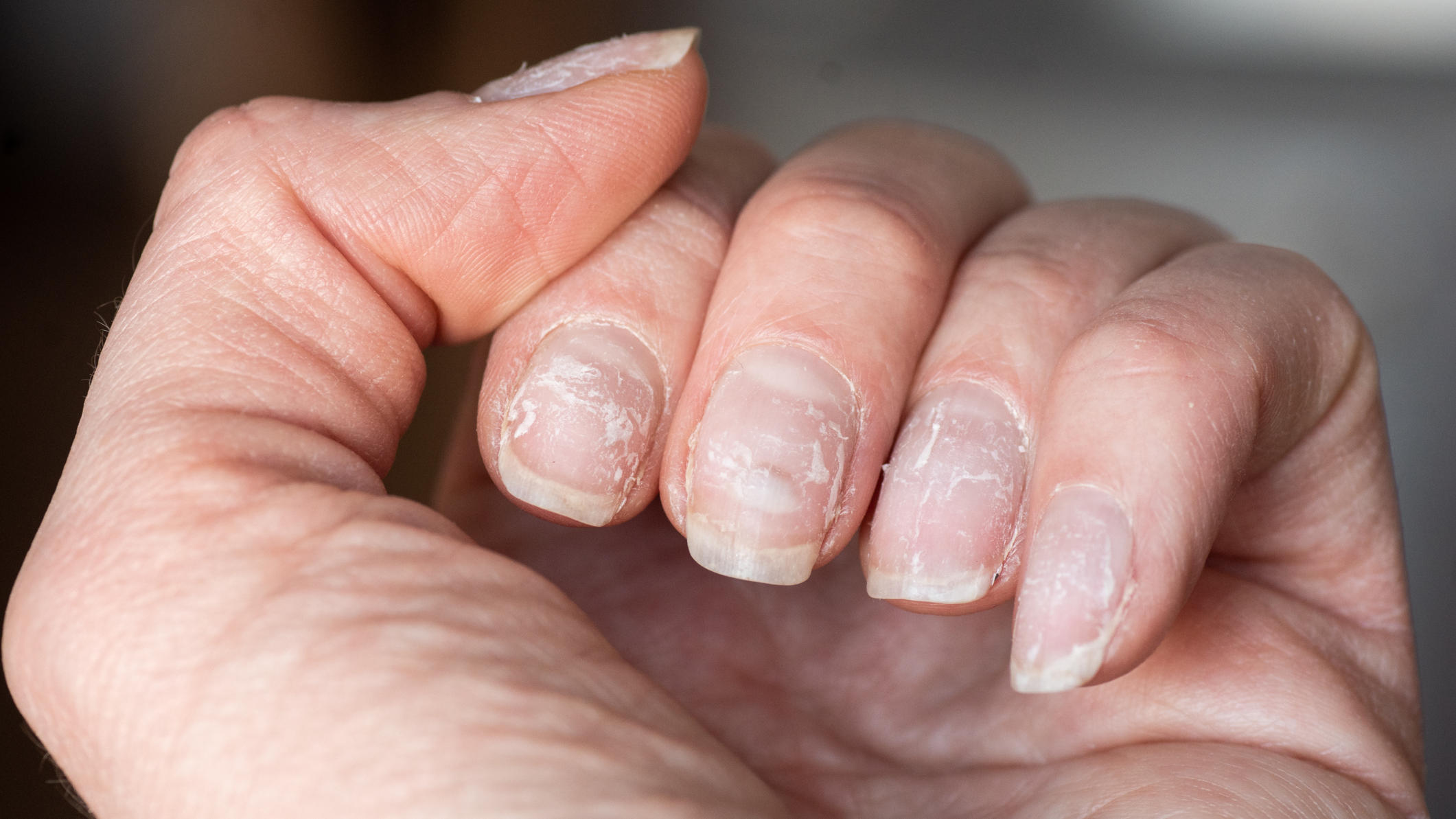 Lungenkrebs an veränderten Fingernägeln erkennen Diese Nagelform kann