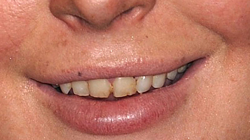 Vor der dentalen Generalüberholung sahen Lindsay Lohans Zähne zum Abgewöhnen aus.