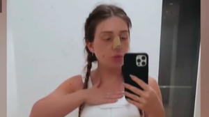 Bibi Claßen zeigt ihre abgeheilte Nase