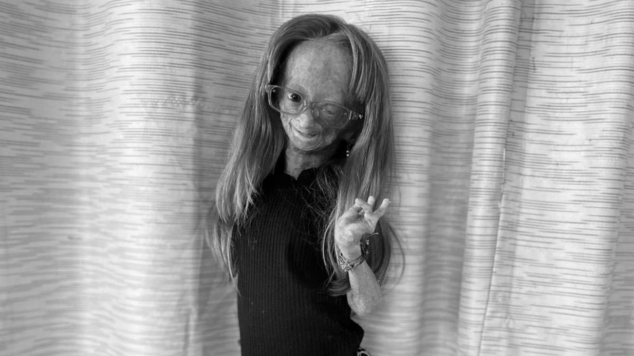 Progerie-YouTube-Star Adalia Rose starb mit nur 15 Jahren.