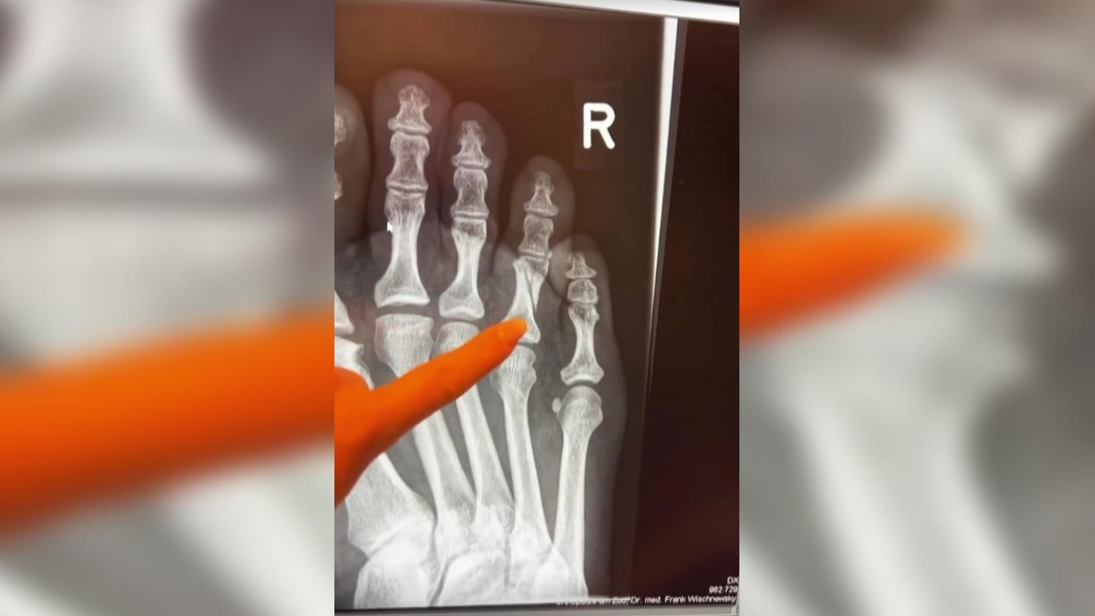 Gebrochener Zeh: Evelyn Burdecki zeigt bei Instagram das Röntgenbild.