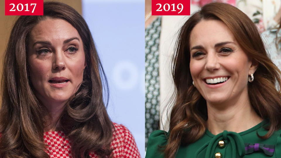 Hat sich Herzogin Kate mit Botox behandeln lassen?