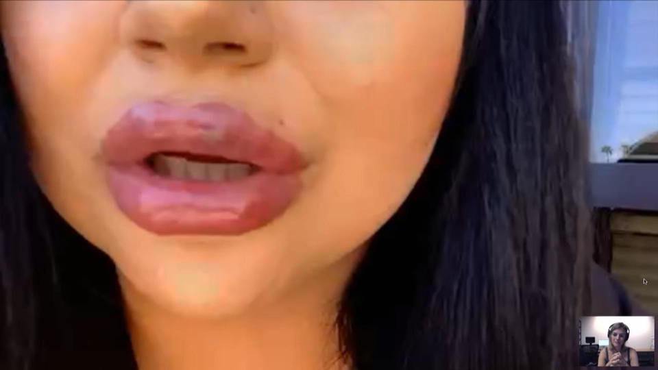 Schlauchboot-Lippen nach Lippenunterspritzung