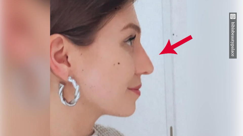 Bibi zeigt auf Instagram ihre verheilte Nase