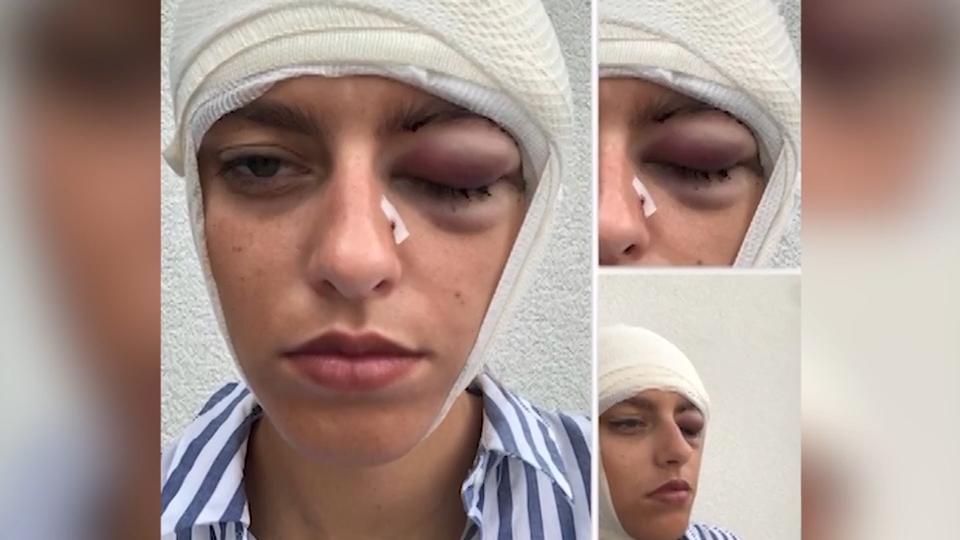 Ex-GNTM-Model Vanessa mit Bierkrug verletzt