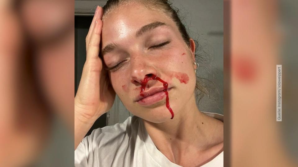 Lola Weippert hat heftiges Nasenbluten